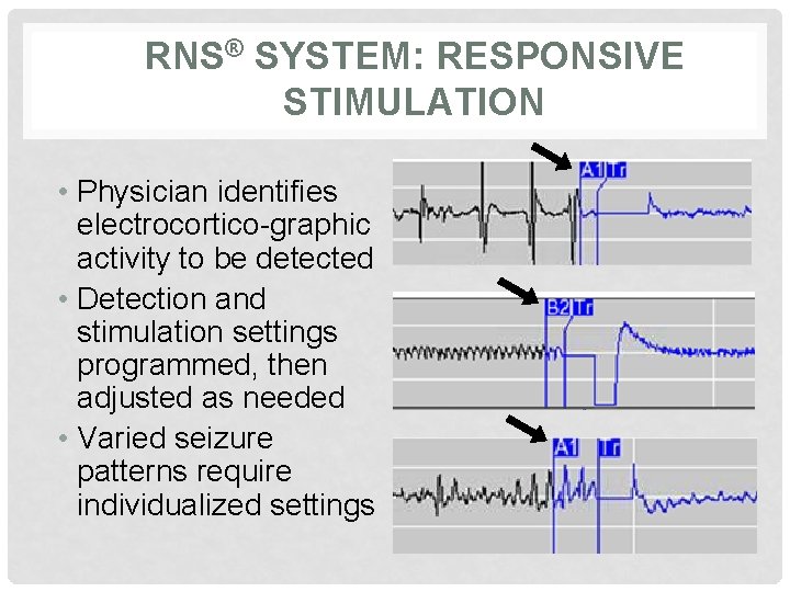 RNS® SYSTEM: RESPONSIVE STIMULATION • Physician identifies electrocortico-graphic activity to be detected • Detection