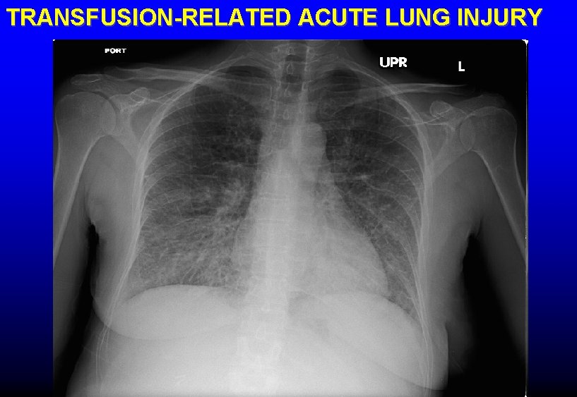 TRANSFUSION-RELATED ACUTE LUNG INJURY 