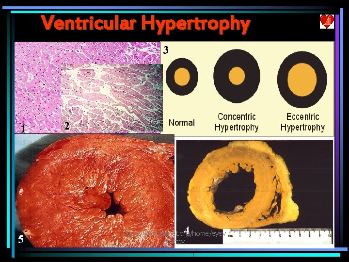 Ventricular Hypertrophy 3 1 5 2 4 http: //www. ctsnet. org/home/eyev stratov 3 