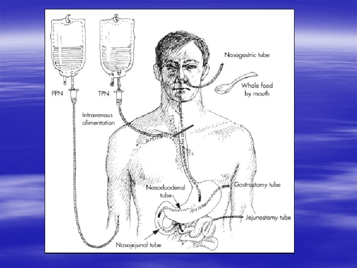 PPN CPN Superior Vena Cava 