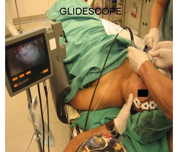 GLIDESCOPE 