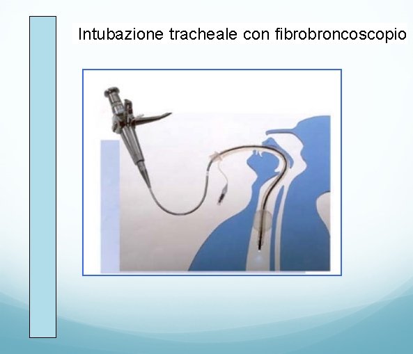 Intubazione tracheale con fibrobroncoscopio. 