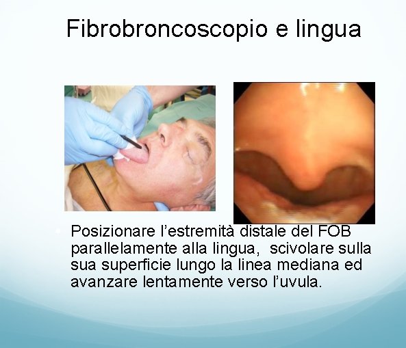 Fibrobroncoscopio e lingua • Posizionare l’estremità distale del FOB parallelamente alla lingua, scivolare sulla