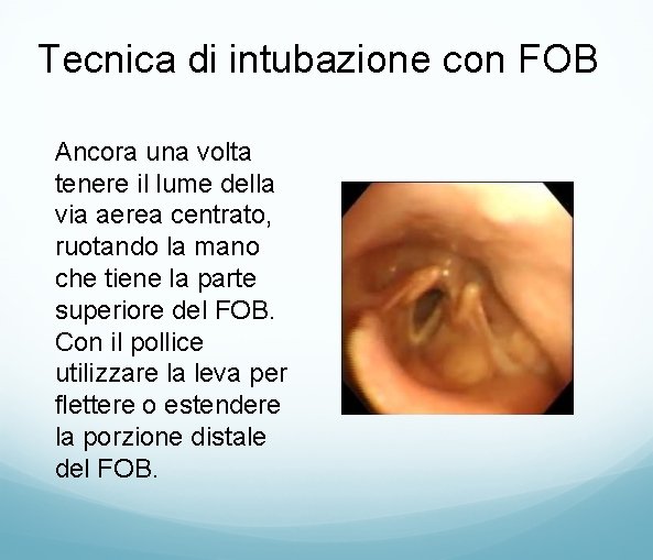 Tecnica di intubazione con FOB Ancora una volta tenere il lume della via aerea