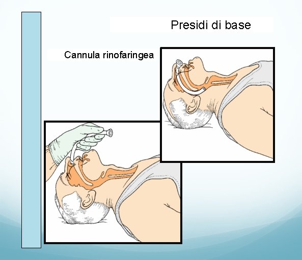 Presidi di base Cannula rinofaringea 