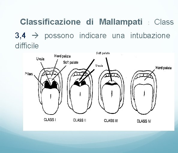 Classificazione di Mallampati : Class 3, 4 possono indicare una intubazione difficile Soft palate