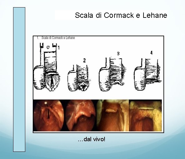 Scala di Cormack e Lehane …dal vivo! 