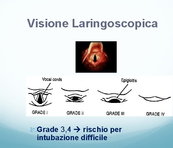 Visione Laringoscopica Grade 3, 4 rischio per intubazione difficile 