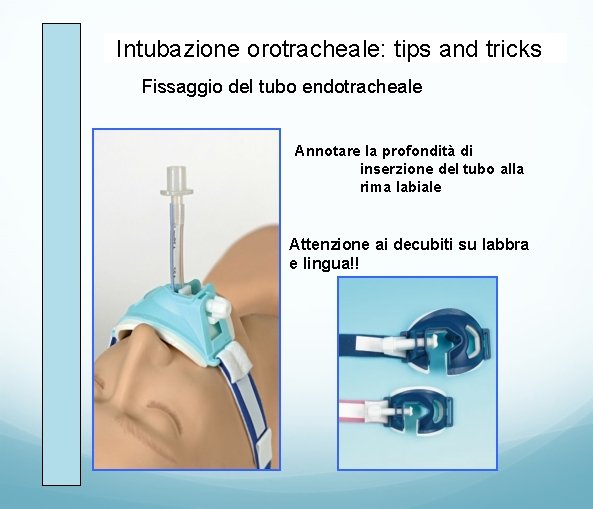 Intubazione orotracheale: tips and tricks Fissaggio del tubo endotracheale Annotare la profondità di inserzione