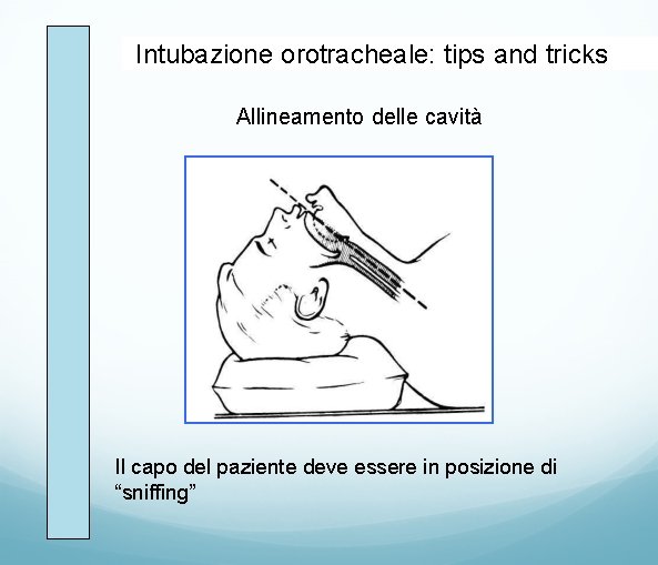 Intubazione orotracheale: tips and tricks Allineamento delle cavità Il capo del paziente deve essere