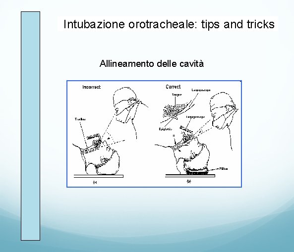 Intubazione orotracheale: tips and tricks Allineamento delle cavità 