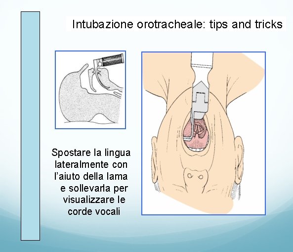 Intubazione orotracheale: tips and tricks Spostare la lingua lateralmente con l’aiuto della lama e