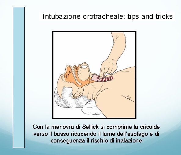 Intubazione orotracheale: tips and tricks Con la manovra di Sellick si comprime la cricoide