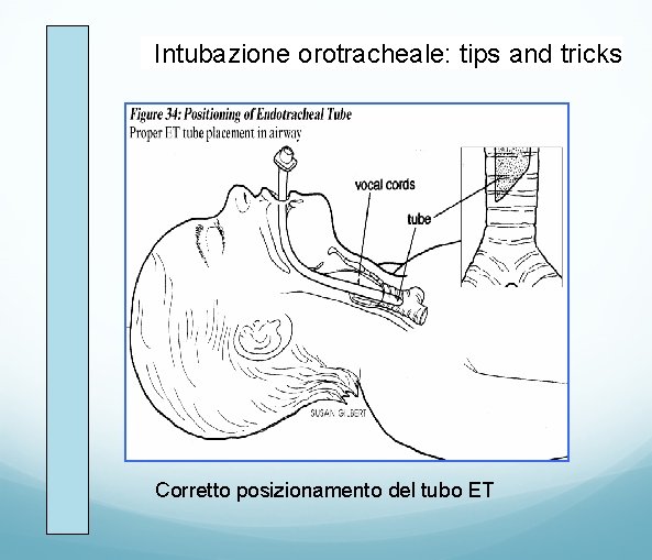 Intubazione orotracheale: tips and tricks Corretto posizionamento del tubo ET 