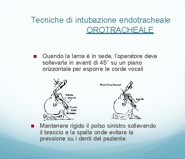 Tecniche di intubazione endotracheale OROTRACHEALE Quando la lama è in sede, l’operatore deve sollevarla