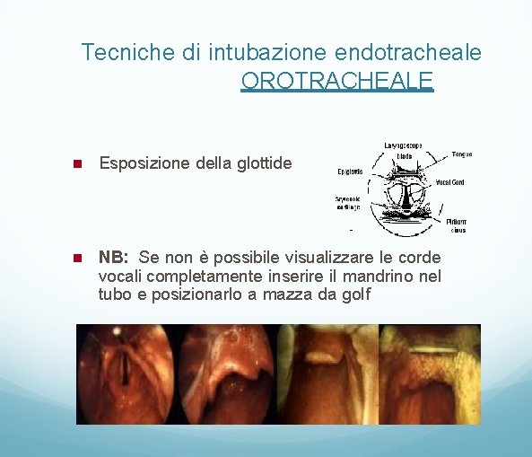 Tecniche di intubazione endotracheale OROTRACHEALE Esposizione della glottide NB: Se non è possibile visualizzare