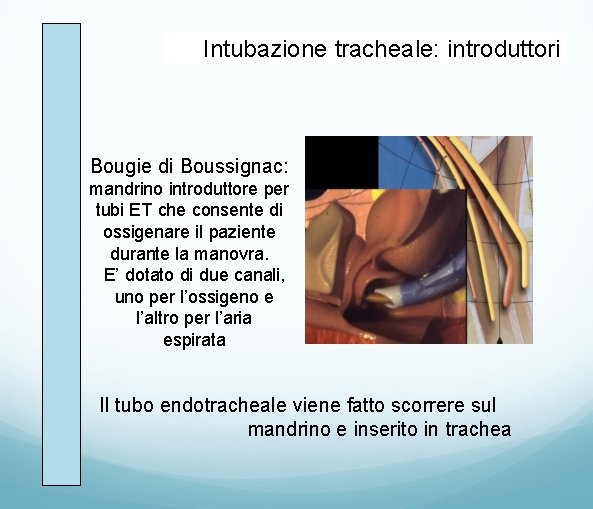 Intubazione tracheale: introduttori Bougie di Boussignac: mandrino introduttore per tubi ET che consente di