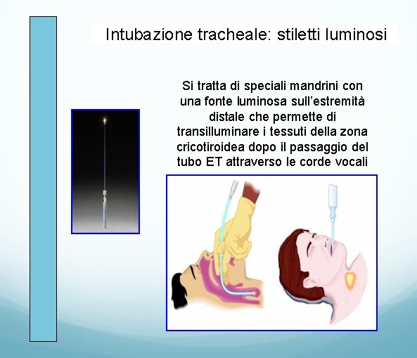 Intubazione tracheale: stiletti luminosi Si tratta di speciali mandrini con una fonte luminosa sull’estremità