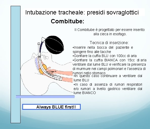 Intubazione tracheale: presidi sovraglottici Combitube: Il Combitube è progettato per essere inserito alla cieca