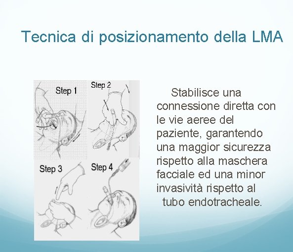 Tecnica di posizionamento della LMA Stabilisce una connessione diretta con le vie aeree del