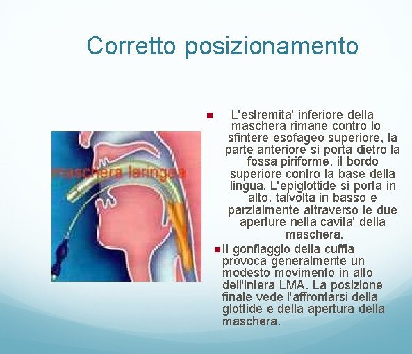 Corretto posizionamento L'estremita' inferiore della maschera rimane contro lo sfintere esofageo superiore, la parte