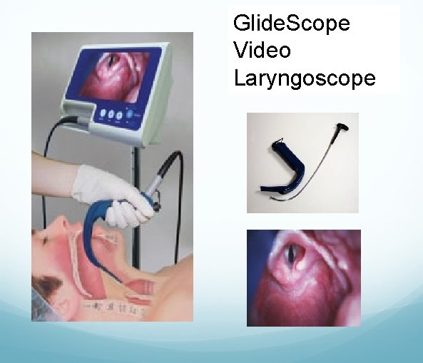 Glide. Scope Video Laryngoscope 