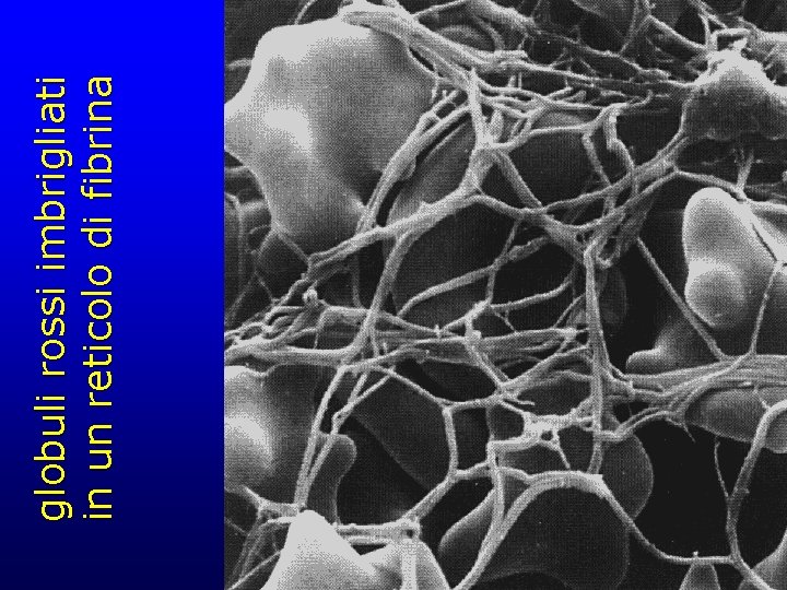 globuli rossi imbrigliati in un reticolo di fibrina 