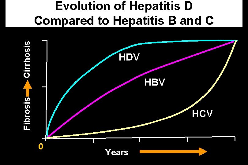 Cirrhosis Evolution of Hepatitis D Compared to Hepatitis B and C HDV Fibrosis HBV Cirrhosis Evolution of Hepatitis D Compared to Hepatitis B and C HDV Fibrosis HBV