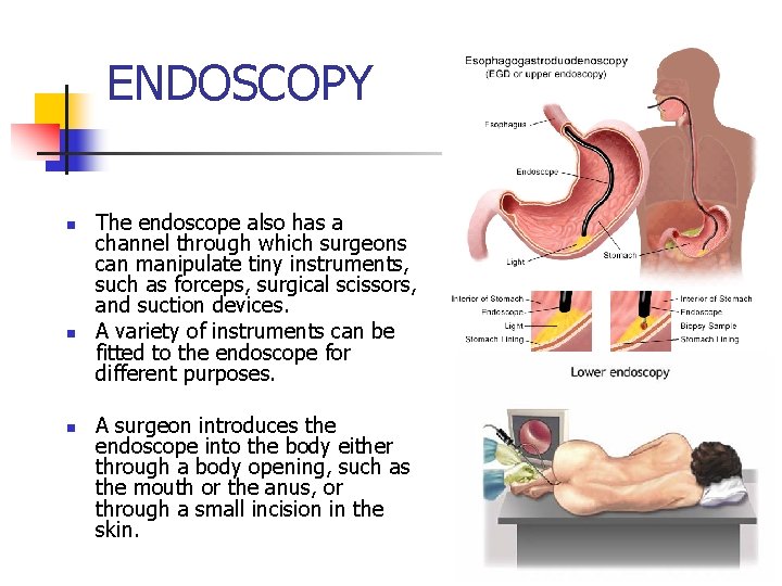 ENDOSCOPY n n n The endoscope also has a channel through which surgeons can