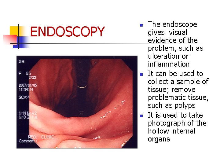 ENDOSCOPY n n n The endoscope gives visual evidence of the problem, such as