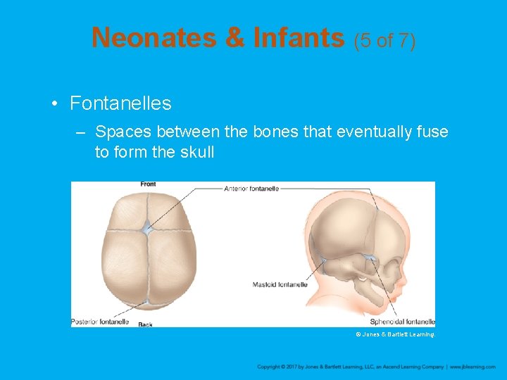 Neonates & Infants (5 of 7) • Fontanelles – Spaces between the bones that