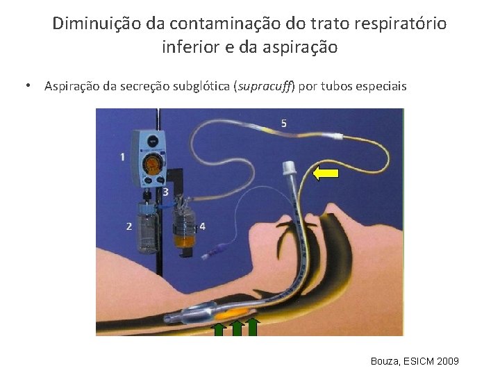 Diminuição da contaminação do trato respiratório inferior e da aspiração • Aspiração da secreção