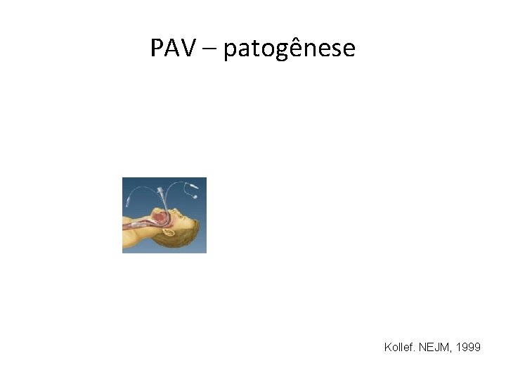 PAV – patogênese Kollef. NEJM, 1999 