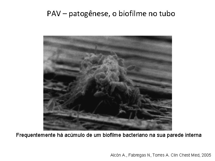 PAV – patogênese, o biofilme no tubo Frequentemente há acúmulo de um biofilme bacteriano