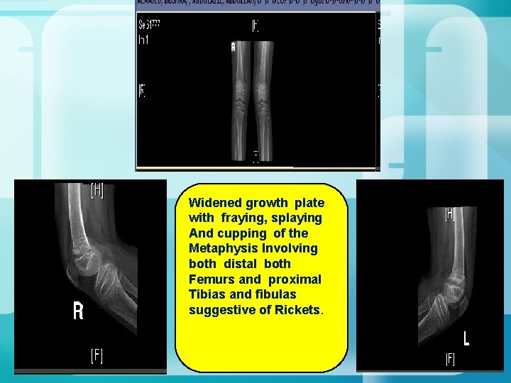 Widened growth plate with fraying, splaying And cupping of the Metaphysis Involving both distal Widened growth plate with fraying, splaying And cupping of the Metaphysis Involving both distal