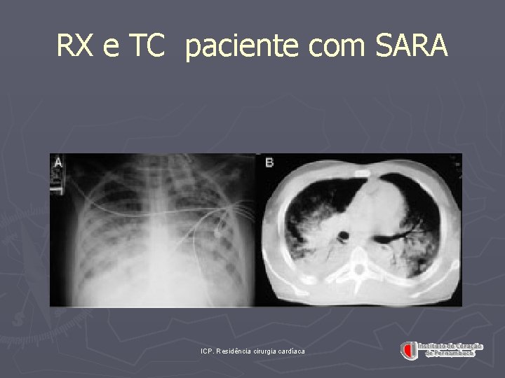 RX e TC paciente com SARA ICP. Residência cirurgia cardíaca 