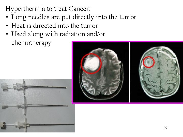 Hyperthermia to treat Cancer: • Long needles are put directly into the tumor •