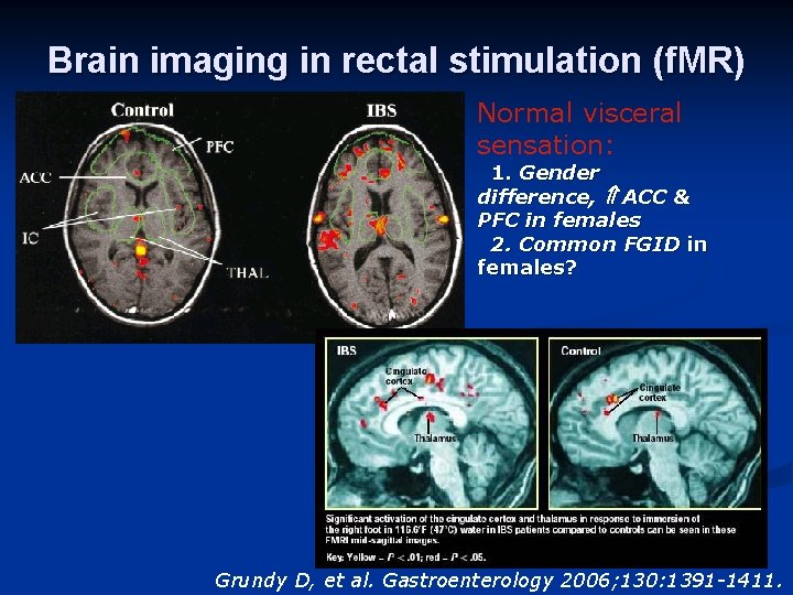 Brain imaging in rectal stimulation (f. MR) Normal visceral sensation: 1. Gender difference, ACC