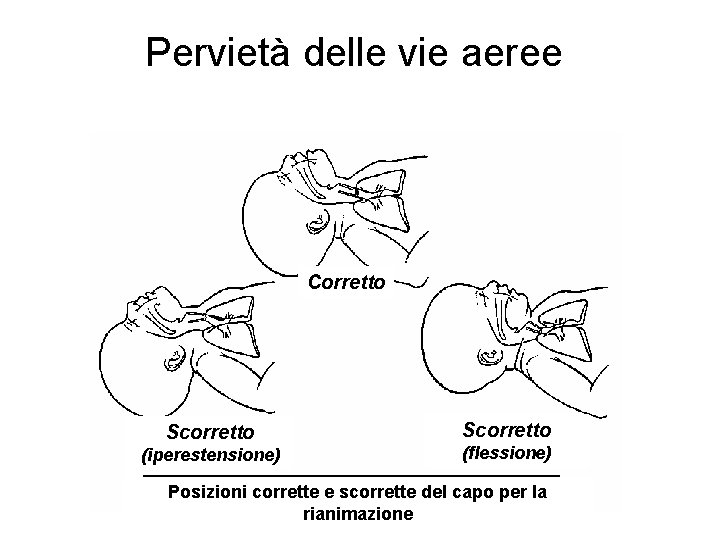 Pervietà delle vie aeree Corretto Scorretto (iperestensione) Scorretto (flessione) Posizioni corrette e scorrette del