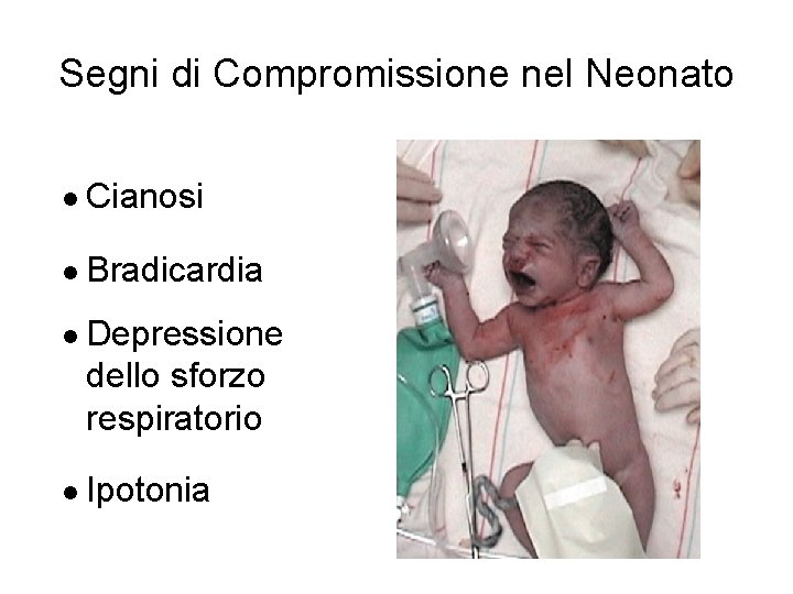 Segni di Compromissione nel Neonato l Cianosi l Bradicardia l Depressione dello sforzo respiratorio