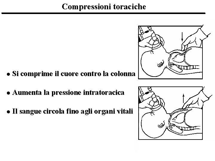 Compressioni toraciche l Si comprime il cuore contro la colonna l Aumenta la pressione