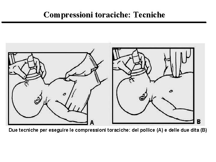 Compressioni toraciche: Tecniche Due tecniche per eseguire le compressioni toraciche: del pollice (A) e