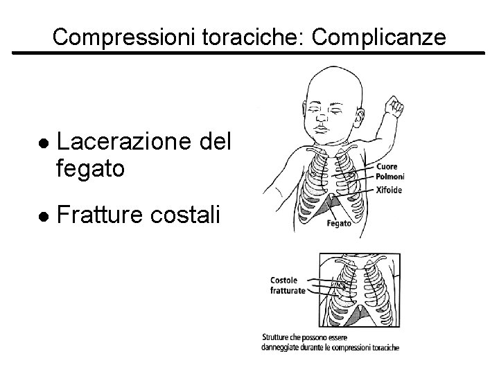 Compressioni toraciche: Complicanze l Lacerazione del fegato l Fratture costali 