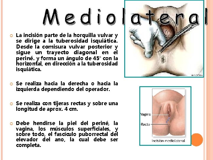 La incisión parte de la horquilla vulvar y se dirige a la tuberosidad La incisión parte de la horquilla vulvar y se dirige a la tuberosidad