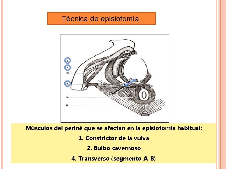 Técnica de episiotomía. Músculos del periné que se afectan en la episiotomía habitual: 1. Técnica de episiotomía. Músculos del periné que se afectan en la episiotomía habitual: 1.