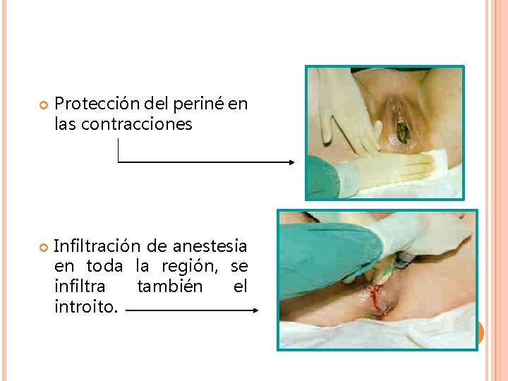 Protección del periné en las contracciones Infiltración de anestesia en toda la región, Protección del periné en las contracciones Infiltración de anestesia en toda la región,