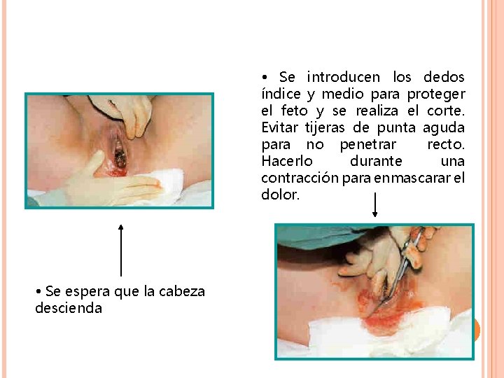 • Se introducen los dedos índice y medio para proteger el feto y • Se introducen los dedos índice y medio para proteger el feto y