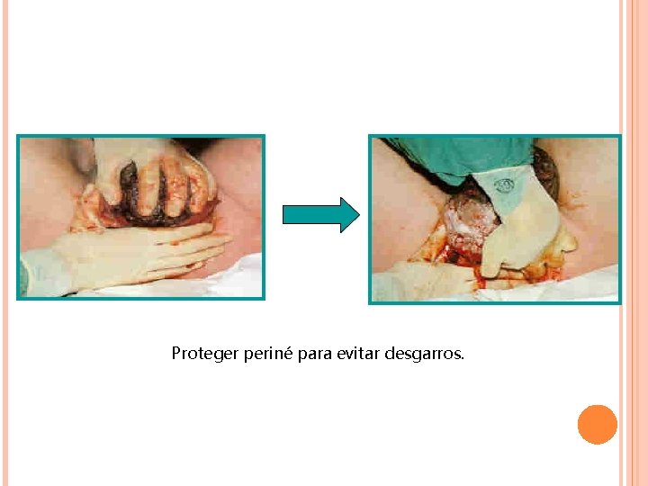 Proteger periné para evitar desgarros. Proteger periné para evitar desgarros.