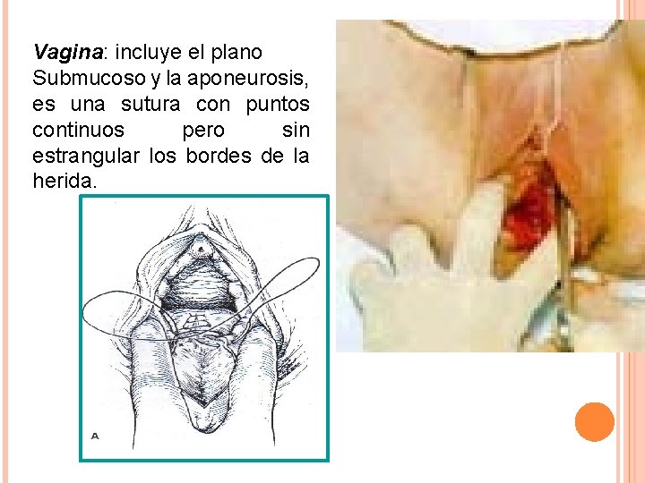 Vagina: incluye el plano Submucoso y la aponeurosis, es una sutura con puntos continuos Vagina: incluye el plano Submucoso y la aponeurosis, es una sutura con puntos continuos