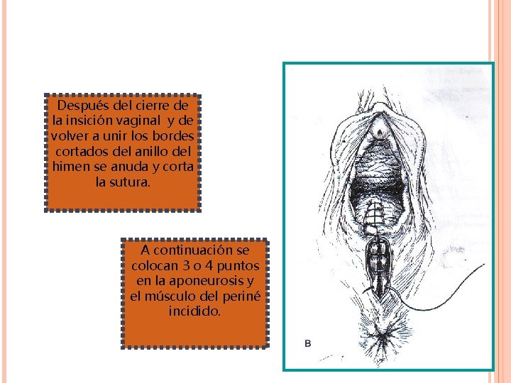 Después del cierre de la insición vaginal y de volver a unir los bordes Después del cierre de la insición vaginal y de volver a unir los bordes